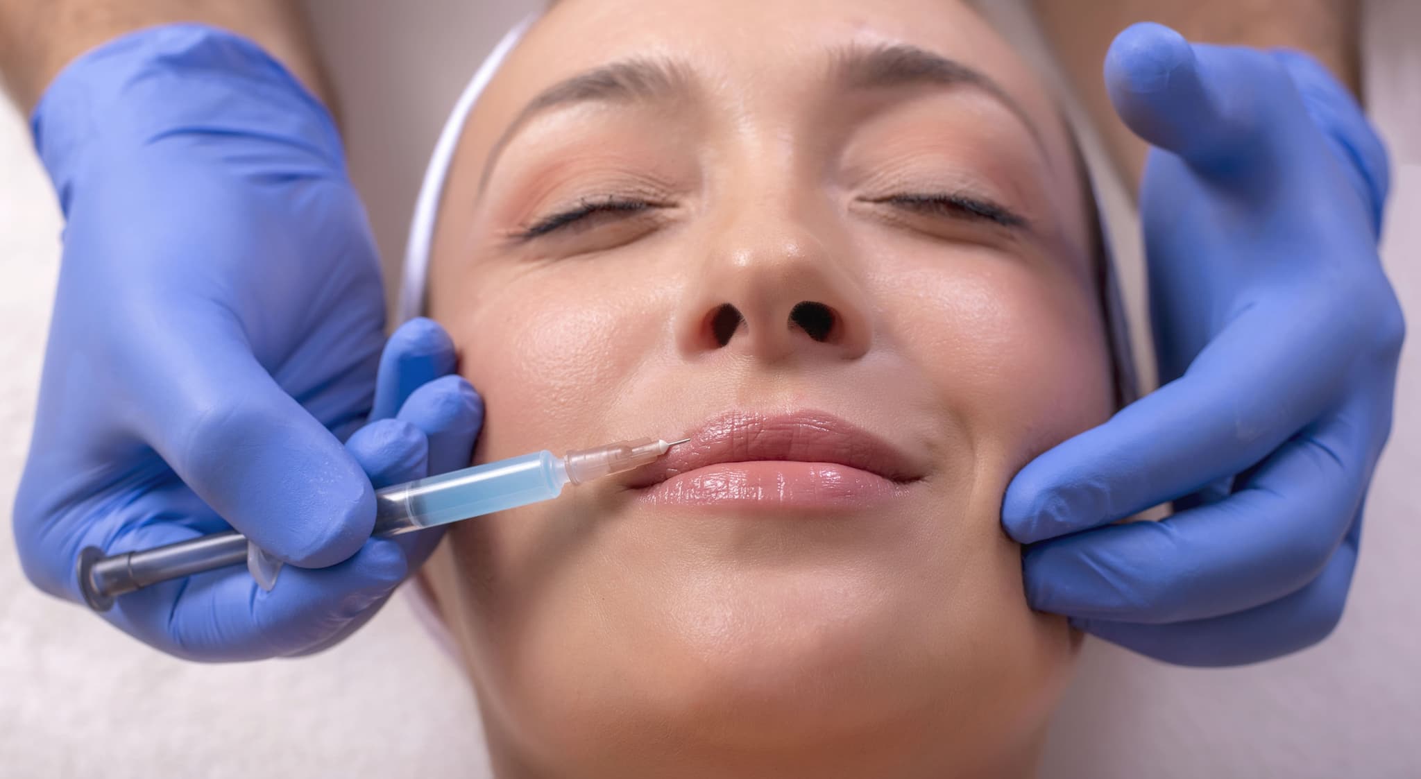 Hyaluronic Acid Fillers
