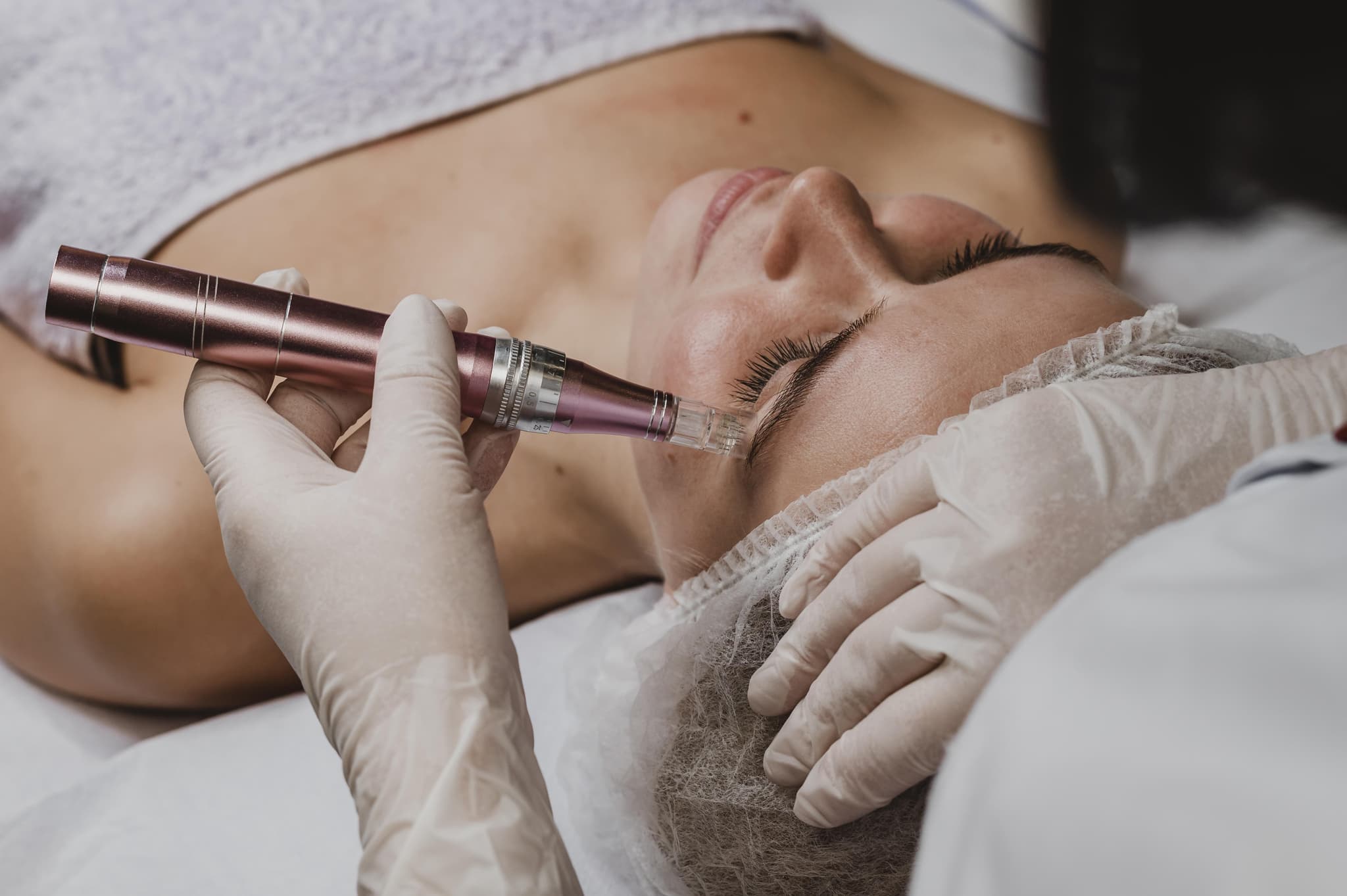 RF Microneedling